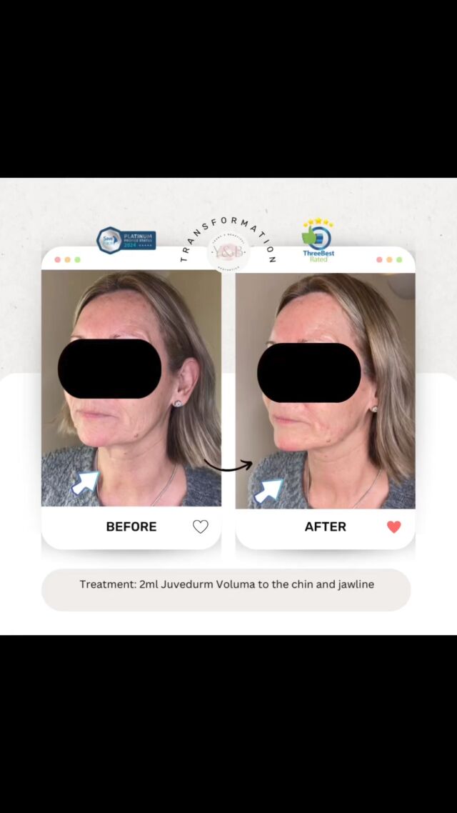 ✨ Chin and jawline makeover complete! Say goodbye to pre jowel sulcus and hello to a more sculpted and youthful appearance with 2ml of Juvederm Voluma. 🌟 This natural enhancement adds volume and definition for a balanced and rejuvenated look. Ready to redefine your features? Book your consultation now! 💫 #ChinAugmentation #JawlineContouring #NaturalResults #JuvedermTransformation