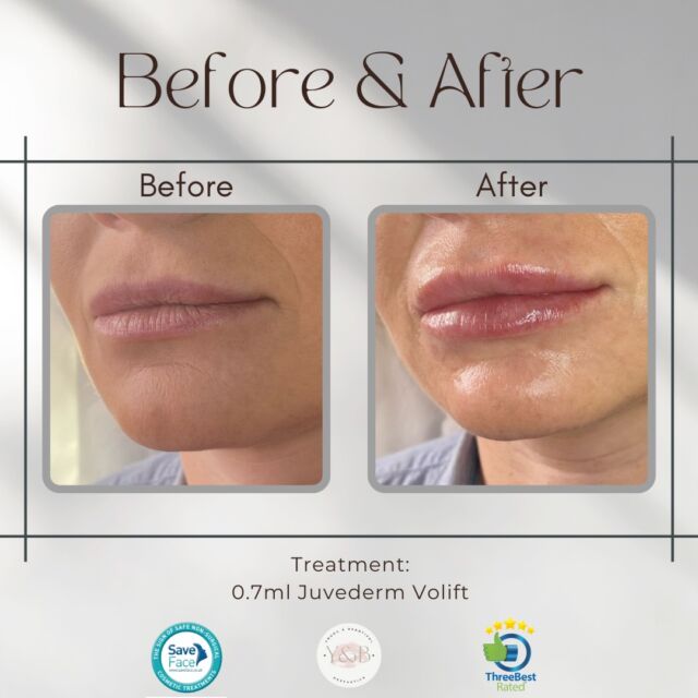 Subtle yet stunning transformation 👄✨Elevating natural beauty with a 0.7ml top-up of Juvederm Volift. Our lovely patient's lips are now perfectly enhanced, radiating confidence and allure.Looking to start your lip filler journey with us? Book in for a consultation online or pop us a message 💕#lipfillernorthamptonshire  #patienttransformations #beforeandafter #juvedermvolift #dermalfillernorthamptonshire #registerednurses #youngandbeautifulaesthetics