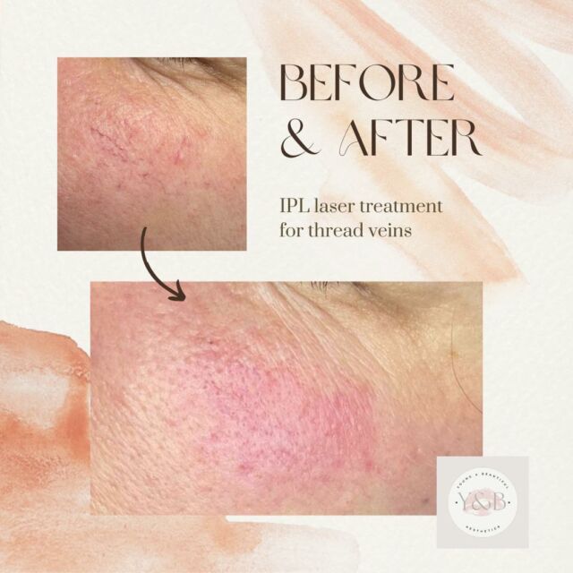Eliminate facial thread veins with our advanced IPL laser treatment. Tiny thread veins and vascular lesions on the face are commonly caused by factors such as sun exposure, genetics, and aging. Our cutting-edge technology targets and eliminates these veins revealing a clear and rejuvenated complexion. Experience the transformative results for yourself!#IPL #Skincare #SpiderVeins #FacialThreadVeins #lyntonlasersuk #weuselynton