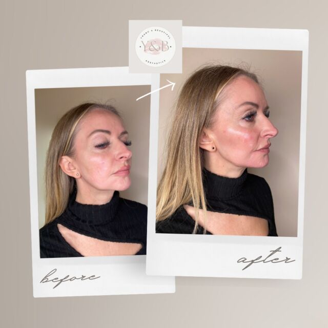 Results following our training day ✨During the training day we used Juvederm dermal fillers to add volume to the cheeks, which can often loose fullness and definition with age. By strategically placing fillers along the jawline, we were able to create a more sculpted and contoured look. The pre jowel sulcus, the area between the chin and jawline that can deepen over time, was also filled in to smooth out the area and reduce the appearance of sagging skin.The results are natural looking and long-lasting, giving our patient a refreshed and youthful appearance.If you're interested in learning more about dermal fillers and how they can enhance your appearance, feel free to reach out for a consultation 💕#ContinuingEducation #MidFaceEnhancement #YouthfulRadiance #JuvedermTraining #PatientTransformations #antiaging #aesthetics #aestheticmedicine #naturalresults #juvedermfiller #youngandbeautifulaesthetics #jawlinefiller #cheekfiller #dermalfillersnorthamptonshire