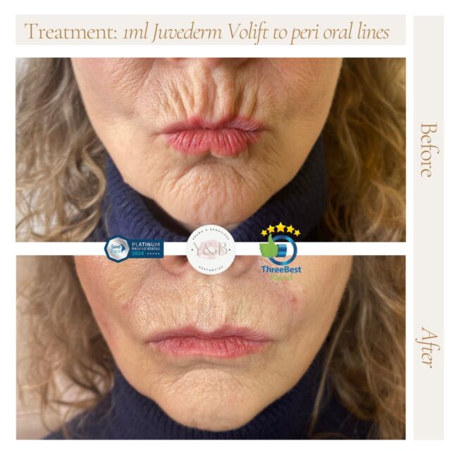 Transforming peri-oral lines with precision and expertise. ✨Our patient wanted to soften her peri oral lines and achieve a more youthful appearance, and the results speak for themselves. The subtle enhancement with 1ml Juvederm Volift has left her looking refreshed and rejuvenated.If you're interested in achieving similar results, book in for a consultation with us today 💕
#aesthetics #juvedermfiller #aestheticsnorthampton #dermalfiller #medicalaesthetics #aestheticsnorthamptonshire #medicalaestheticsclinic #juvedermvolift #juvederm #naturalresult #dermalfillernorthampton #dermalfillernorthamptonshire #registerednurses #youngandbeautifulaesthetics #antiaging