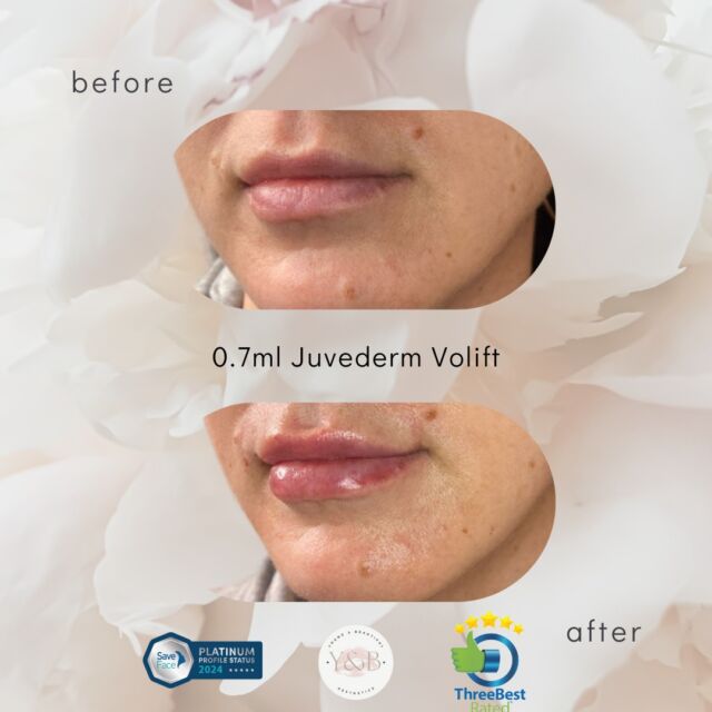 👄Enhancing natural beauty with 0.7ml Juvederm Volift lip filler 👄Witness the subtle yet transformative results of our patient's 0.7ml top-up lip filler treatment. Using Juvederm Volift, we were able to achieve soft, natural looking lips that enhance her features and boost her confidence.Interested in achieving a similar result? Book an appointment to experience the artistry of lip augmentation done right 💕#lipfiller #lipaugmentation #juvederm #juvedermlips #naturalresult #beforeandafter #dermalfillernorthampton #dermalfillernorthamptonshire #juvedermvolift #lipfillernorthampton #lipfillernorthamptonshire #registerednurses #youngandbeautifulaesthetics