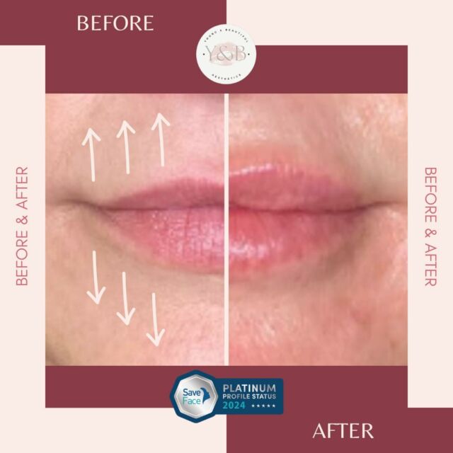 ✨ Lip Augmentation following 1ml Juvederm Volift ✨Before lip augmentation:
- Thin upper lip with minimal volume
- Lack of definition in the cupids bow
- Uneven shape and size of the upper and lower lipsAfter lip augmentation with 1ml Juvederm volift:
- Fuller and plumper lips with increased volume
- Enhanced definition in the lip border
- Symmetrical shape and size of the upper and lower lips
- Natural-looking results with a subtle enhancement in the overall appearance of the lipsReady to start your lip filler journey with us? 💋Book in for a consultation today 💕#dermalfillernorthamptonshire #registerednurses #beforeandafter #juvederm #juvedermlips #juvedermfiller #juvedermvolift #lipaugmentation #lipaugmentationnorthampton #youngandbeautifulaesthetics
