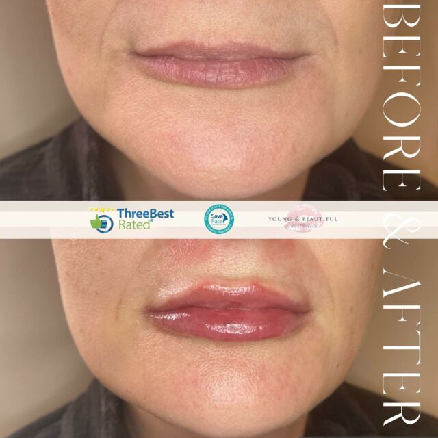 💘 is in the air…
And to us, it looks like this!A beautiful before and after providing us with ALL the lip filler feels.With an already amazing natural shape, a little magic 🪄 has enhanced, defined and given these lips the volume they deserve 💖Ready to start your lip journey?
Or needed this to remind you to book in your next appointment? Drop us a message 💌
#LipAugmentation #AestheticsClinicNorthampton #LipFiller #NurseInjector #AestheticsNorthampton #Wollaston #FacialFiller #DermalFiller #FaceAesthetics #SkinClinic #NonSurgical #BeforeAndAfter