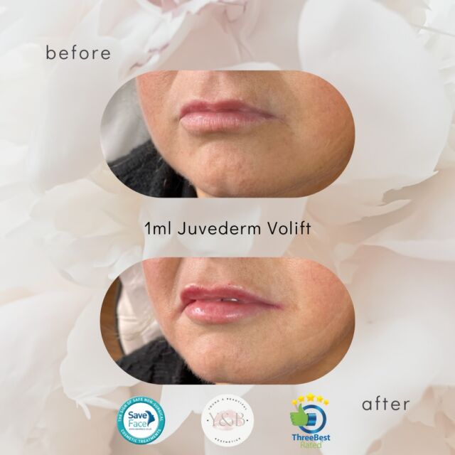✨ Lip rejuvenation with 1ml Juverderm Volift ✨💋Our lovely patient presented with a lack of volume in the upper lip and asymmetry to the lower lip. The lips also showed signs of aging, with fine lines and a decrease in lip fullness. The patient expressed a desire for a natural and subtle enhancement to achieve a more youthful and defined lip appearance.After the administration of 1ml of Juvederm Volift using a cannula technique, the lips exhibited a noticeable improvement in volume and definition. The filler helped to plump up the lips, creating a more balanced and symmetrical appearance with the overall shape of the lips enhanced. The filler also helped to smooth out fine lines and wrinkles, giving the lips a smoother and more rejuvenated look.Overall, the lip filler treatment with Juvederm Volift provided the patient with a soft and natural enhancement, resulting in fuller, more youthful-looking lips. The cannula technique used for the injection helped to minimize bruising and discomfort, ensuring a comfortable and safe procedure for the patient.Thinking of starting your lip filler journey with us? 💋 why not book in for a consultation or pop us a message 💕#Juverderm #juvedermlips #lipfillersnorthampton #lipfillersnorthamptonshire #volift #juvedermvolift #aestheticsnorthamptonshire #aestheticsnorthampton #naturaldermalfiller #natural #results #naturalresults #before #after #beforeandafter #registerednurses #youngandbeautifulaesthetics