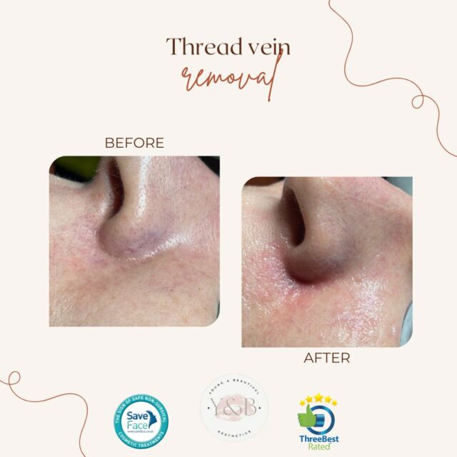 Facial thread veins (telangiectasia) are small superficial red veins that occur around the nose, across the cheeks and/or chin. We use our Lynton 3Juve to heat the blood vessels, to a point where they are destroyed. After your treatment, the vessels quickly clear as they are reabsorbed by the body, leaving little or no trace of the original lesion.#weuselynton #laserskintreatment #laserskinclinic #laserskintreatments  #laserskinandwellness #laserskinspecialist #skinlasers #skinlasertreatment #skinlaserclinic  #pigmentationremoval #pigmentationsolution #lyntonlasers #acnescars #acnescar #freckles  #acnetreatment #clearskin #rosacea #threadveinremovalnorthampton #laserclinicnorthampton #laserclinicnorthamptonshire #youngandbeautifulaesthetics
