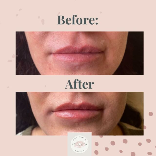 Enhance your lips with our natural-looking lip filler treatment using 1ml of Juvederm Volift. This carefully curated treatment enhances the shape and volume of your lips, providing a natural and beautiful result.
Say goodbye to thin lips and hello to the perfect pout you've always wanted. Book your appointment today to achieve your lip enhancement goals! 💕#lipfiller #JuvedermVolift #beforeandafter #naturalbeauty