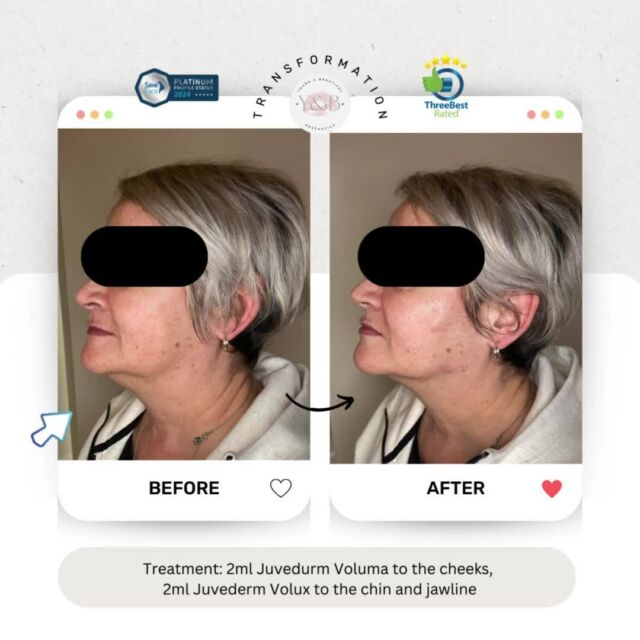 ✨Our lovely patient was bothered by the area under her chin and was wanting a more defined jawline. By using 2ml Voluma to strategically enhance the cheeks and 2ml Juvederm Volux to sculpt and define the jaw and chin area we were able to improve this area by restoring volume and contouring the face for a subtle yet impactful change in facial structure and profile.✨Utilizing premium brand products like Juvederm Voluma and Volux is crucial for achieving optimal results in facial rejuvenation. These high-quality fillers offer superior volumizing and contouring properties, ensuring natural-looking and long-lasting outcomes.Interested in dermal fillers? Book a consultation to see how we can help 💕#aestheticsnorthamptonshire #aesthetics #aestheticsclinic #medicalaesthetics #aestheticsnorthampton #antiwrinkle #dermalfiller #dermalfillernorthampton #dermalfillernorthamptonshire #chinfiller #cheekfiller #cheekfillernorthampton #jawfiller #juvedermfiller #juvederm #juvedermvolux #juvedermvoluma #registerednurses #youngandbeautifulaesthetics