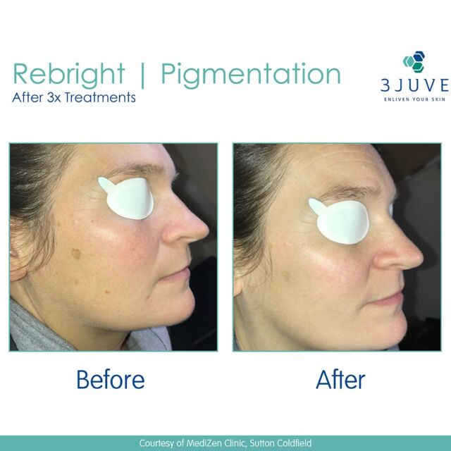 ✨Glowing, rejuvenated skin is just a Lynton Skin Rejuvenation treatment away. With our medical-grade Lynton IPL we can reduce brown spots, hyperpigmentation and redness.✨IPL Skin Rejuvenation uses broad wavelengths of light to regenerate new collagen in your skin cells. Making your skin smoother, vibrant and younger-looking!✨Laser consultations are free, why not book in to see how we can help you to transform your skin? 💕#weuselynton #laserskintreatment #laserskinclinic #laserskintreatments  #laserskinandwellness #laserskinspecialist #skinlasers #skinlasertreatment #skinlaserclinic  #pigmentationremoval #IPLforpigment #pigmentationsolution #lyntonlasers
#pigmentation #skincare #acne #beauty #skin #melasma #laser #antiaging #wrinkles #facial #skinrejuvenation #glowingskin #complexion #sundamage #youngandbeautifulaesthetics #registerednurses