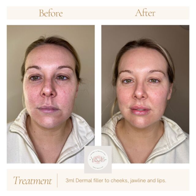 We love subtle tweeks that lead to results like this!The treatment? Our lovely patient had 3ml dermal filler administered to her cheeks, jawline, lips and a tiny amount in the chin.The result? A more defined and lifted contour helping to improve sagging or sunken cheeks and jowls whilst achieving an enhanced facial harmony. Notice how by making the cheeks more defined the under eye area improves and looks more balanced, all whilst maintaining a natural look.Interested in dermal fillers? Book in for a consultation so we can assess your facial structure and provide a personalised recommendation to help you to achieve natural looking results.Book in at our website, call us on 01933 825203 or pop us a message 💕#aestheticsnorthamptonshire #aestheticsnorthampton #juvedermfiller #Juvederm #dermalfiller #naturalresults #juvédermvoluma® #juvedermvolumacheeks #cheekfiller #cheekfillersnorthampton #lipfiller #juvedermvolift💋 #lipfillerbeforeandafter #lipfillernorthampton #Filterfree #aesthetics #dermalfillersbeforeandafter #youngandbeautifulaesthetics #registerednurses