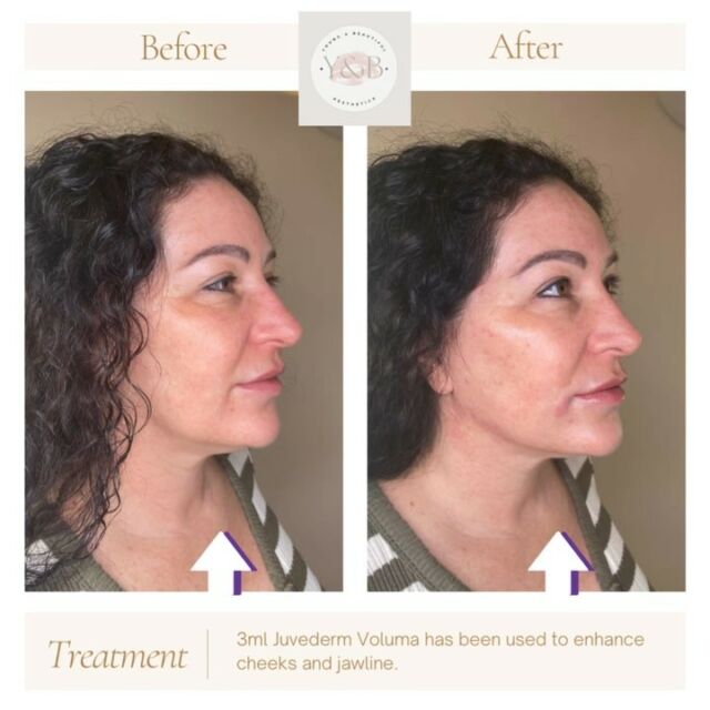 Revitalize and redefine your mid-face and jawline with our precise dermal filler treatment. Here we have used 3ml Juvederm Voluma to the mid face and jawline to improve the definition and symmetry of this area, resulting in a more sculpted and balanced appearance.This hyaluronic acid filler is expertly crafted to restore lost volume and enhance facial contours, providing a natural and rejuvenated look. We will customise the treatment to your unique facial anatomy, ensuring a safe and effective procedure.Experience the transformative power of Juvederm Voluma and book your consultation today to discover how it can enhance your facial features 💕#JuvedermVoluma #facialcontouring #beforeandafter #medicalaesthetics