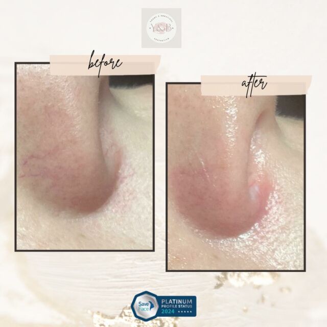 ✨ Say goodbye to unwanted thread veins with our 3JUVE laser treatment, powered by IPL (Intense Pulsed Light) technology, for clear and smooth skin ✨ #GoodbyeVeins #lyntonlasers #weuselyntonlasers #threadveinremoval #youngandbeautifulaesthetics #IPL