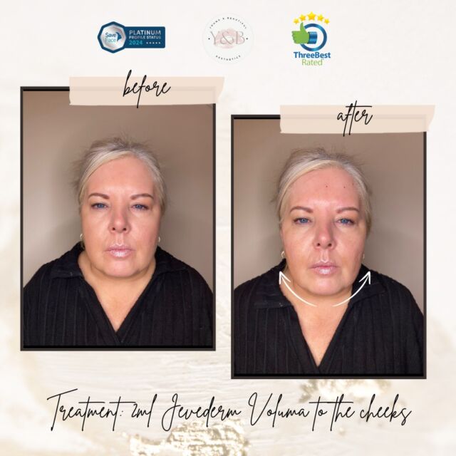 ✨This before and after showcases the transformative effects of Juvederm Voluma in addressing age-related volume loss. By enhancing the cheeks creating lift and contouring there is a noticeable lift in the jowel area creating an enhanced facial symmetry and definition.✨Contact us for a consultation and to see if we can help you to achieve a refreshed, rejuvenated appearance! 💕#juvedermfiller #antiwrinkle #aestheticsclinic #dermalfiller #cheekfiller #aestheticsnorthampton #aesthetics #medicalaesthetics #aestheticsnorthamptonshire #medicalaestheticsnurse #aestheticnurse #medicalaestheticsclinic #aesthetician #juvedermvoluma #midfacefillers #naturalresult #dermalfillernorthamptonshire #registerednurses #Saveface #Professionalism #PatientCare #naturalresults #juvédermvoluma® #MidFaceEnhancement #dermalfillersbeforeandafter #YouthfulRadiance #youngandbeautifulaesthetics