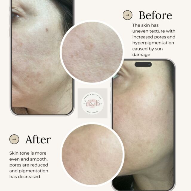 Patience and consistency are key when it comes to achieving flawless skin. Look at this amazing transformation after 3 illumifacials, 1 Phformula TCA touch treatment, and consistent use of Phformula homecare products plus daily SPF! ✨These before and after photos show the incredible results that can be achieved with the right treatments and products. Remember, invest in your skin because you wear it every day! 💫Ready to start your skincare journey? Why not book in for a consultation to see how we can help 💕#phformulauki #weuselyntonlasers #skincarejourney #illumifacial #ipl #phformulatreatments #flawlessskin #patienceiskey #consistencyiskey #dailySPF