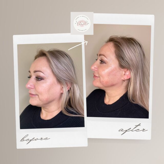 Training day results part 2✨During our recent training day we used Juvederm dermal fillers to achieve full face rejuvenation for our patient. By enhancing the cheeks, defining the jawline, and filling the pre jowel sulcus, we were able to create a more balanced and youthful appearance. The fillers added volume to lift the cheeks, whilst also providing structure and contour to the jawline. Filling in the pre jowel sulcus which is the dip between the chin and jawline, helped to smooth out the area and improve the overall symmetry of the face. We added a subtle lip filler to create a more youthful and rejuvenated appearance.This treatment is part of a full face rejuvenation approach, where we aim to enhance multiple areas to provide a harmonious and balanced look ✨If you 're interested in achieving a similar transformation, don't hesitate to reach out for a consultation! 💕#ContinuingEducation #MidFaceEnhancement #naturalresults #antiaging #cheekfiller #nonsurgical #juvedermlips #juvedermvolift #dermalfiller #registerednurses #lipfillernorthampton #lipfiller #lipfillerbeforeandafter #aestheticsnorthampton #aestheticsnorthamptonshire #Juvederm #juvédermvoluma® #cheekfillersnorthampton #dermalfillersbeforeandafter #fullfacerejuvenation