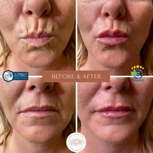 Say goodbye to lipstick bleeding 💄Our lovely patient came to us seeking help to soften her peri oral lines which were bothering her causing her lipstick to bleed and making her feel that they aged her. We were able to soften these using 1ml dermal filler including addressing the vermillion border to lift the top lip and effectively concealing spots where lipstock bleeds.Our patient now exudes confidence with a rejuvenated look. Are you ready to experience the difference with us? Book your consultation today 💕#antiaging #aesthetics #juvedermvolift #medicalaestheticsclinic #lipfillernorthampton #liptransformation #EmpowerBeauty #lipfillernorthamptonshire #lipaugmentation #Juvederm #registerednurses #PatientCare #dermalfillersnorthamptonshire #aestheticnurses #periorallines #BeforeAndAfter #YoungAndBeautifulAesthetics #PeriOralLines