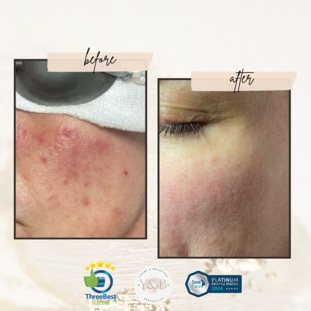 🌟 Rosacea Awareness Month 🌟Did you know that April is Rosacea Awareness Month? Rosacea is a common skin condition that can cause redness, flushing, visible blood vessels on the face and sometimes even acne-like bumps. But with the right treatment, significant improvements can be made!Check out this amazing before and after photo following just 2 sessions of IPL (Intense Pulsed Light) with our 3Juve laser. The results speak for themselves - redness reduced, skin tone evened out, and a noticeable improvement in overall skin texture.If you or someone you know is struggling with rosacea, don't hesitate to reach out for  consultation to see how we can help. IPL therapy is just one of the many effective treatments available for managing rosacea and achieving clear, healthy skin.Let's raise awareness and support those with rosacea this month and beyond! 💕#weuselynton #lyntonlasersuk #RosaceaAwarenessMonth #IPLTreatment #SkincareTransformation #BeforeAndAfterPic #aestheticnurses #youngandbeautifulaesthetics