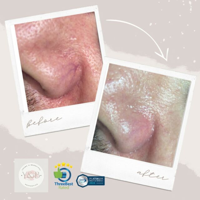 Facial thread veins (telangiectasia) are small superficial red veins that occur around the nose, across the cheeks and/or chin. We use our Lynton 3Juve to heat the blood vessels, to a point where they are destroyed. After your treatment, the vessels quickly clear as they are reabsorbed by the body, leaving little or no trace of the original lesion.Book your appointment today and say hello to clear, beautiful skin! 💫#weuselynton #laserskintreatment #laserskinclinic #laserskintreatments  #laserskinandwellness #laserskinspecialist #skinlasers #skinlasertreatment #skinlaserclinic  #pigmentationremoval #pigmentationsolution #lyntonlasers #acnescars #acnescar #freckles  #acnetreatment #clearskin #rosacea