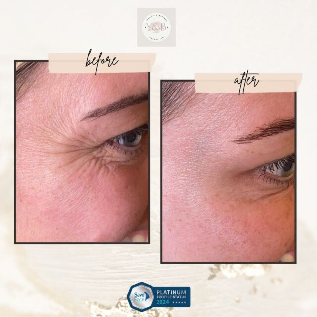 🌟 Say goodbye to crows feet with our wrinkle treatment! ✨See the amazing before and after results. Our client's skin looks smoother and more youthful after just one treatment. Ready to rejuvenate your skin? Book your appointment today!#WrinkleTreatment #CrowsFeet #BeforeAndAfter #TransformationTuesday 💫