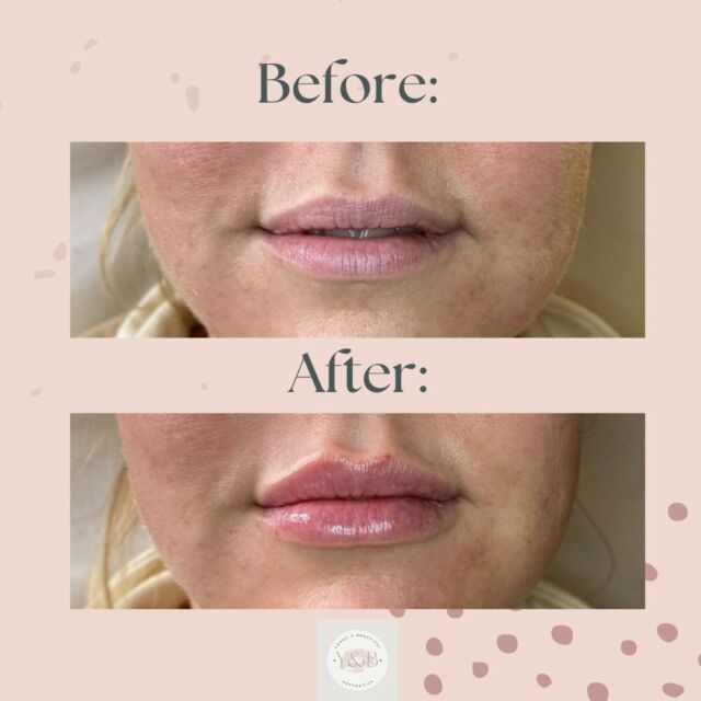Subtle enhancement, stunning results achieved with 1ml Juvederm Volift 👄We have enhanced our lovely patient's lips using a cannula which is our preferred choice when administering lip fillers. The reason for this is a cannula offers increased safety during a lip filler procedure due to the fact it has a blunt tip, reducing the risk of accidently puncturing blood vessels or nerves.There is also minimal downtime with a cannula due to the fact that fewer puncture points are needed, resulting in less trauma to the tissues and a faster recovery time. Many of our patients also report that the cannula is more comfortable due to its smooth and gentle application, and the flexibility and long reach of a cannula allow for better control and accuracy when injecting lip fillers.Have you ever had lip filler with a cannula?If you are interested in this or any of our treatments, book in for a consultation to see how we can help, or pop us a message 💕#registerednurses #aesthetics #Juvederm #aestheticsnorthamptonshire #juvedermfiller #lipfiller #naturalresults #lipfillernorthampton #dermalfiller #lipfillerbeforeandafter #aestheticsnorthampton #Filterfree #juvedermlips #juvedermvolift #youngandbeautifulaesthetics