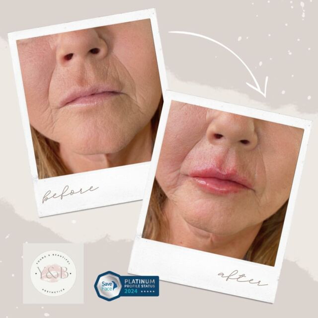 See the real difference 1ml of Juvederm volift lip filler can make for facial balancing. These before and after images showcase the natural enhancement and subtle volume achieved. Elevate your look with precision and expertise for a confident, refined aesthetic. 💋✨Interested in starting your dermal filler journey? Why not book in for a consultation to see how we can help 💕#lipfiller #juvederm #facialbalance #medicalaesthetics #juvedermlips