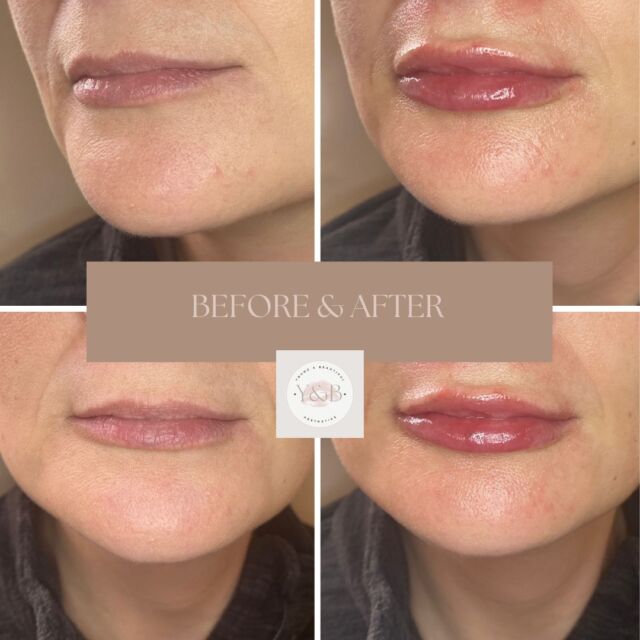 Pre and post lip filler results 👄Here we can see the before and after results of 1ml Volift showing a significant improvement in volume and shape. As well as looking more rejuvenated the presence of lines and wrinkles on the lips is also minimized resulting in a more youthful yet natural appearance.Interested in dermal fillers or any other treatments we offer? Why not book in for a consultation, you can do this on our website or by calling us on 01933 825203 💕#dermalfiller #dermalfiller #Juvederm #juvedermlips #juvedermfiller #juvedermvolift #juvedermvolift #lipfiller #lipfillerbeforeandafter #lipfillernorthampton #lipfillernorthamptonshire #naturalresults #naturalresults #aestheticsnorthampton #aestheticsnorthamptonshire