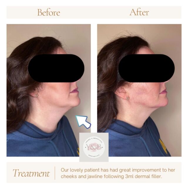 ✨Mid and lower face dermal filler treatment with Juverderm Voluma✨Our lovely patient was bothered by the area under her chin which lacked support and definition, leading to a less defined jawline and neck profile.We treated her cheeks and jawline with Juvederm Voluma dermal filler resulting in a noticeable improvement in the volume and contour of the treated areas. The filler helped to restore lost volume in the cheeks, providing a lifted and more youthful appearance. By enhancing the projection of the jawline, the filler created a more defined and sculpted look, improving the overall symmetry of the face.In particular, the area under the chin received additional support from the filler, resulting in a more defined jawline and a smoother transition from the chin to the neck. The filler helped to contour and shape the lower face, enhancing the patient's natural features and providing a more harmonious facial profile.Overall, the Juvederm Voluma dermal filler treatment effectively improved the volume and definition of the cheeks and jawline, leading to a more youthful, lifted, and rejuvenated appearance.Does the area under your chin bother you? Why not book in for a consultation see how we can help 💕#juvederm #midfacefillers #jawlinefiller #naturalresult #beforeandafter #dermalfillernorthampton #dermalfillernorthamptonshire #registerednurses #youngandbeautifulaesthetics #juvedermvoluma
