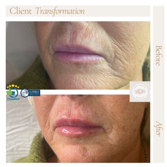 🌿Natural Lip Enhancement with 1ml Juvederm Volift🌿Want fuller, more defined lips without looking overdone? We can help you achieve natural-looking results with Juvederm Volift. This hyaluronic acid filler adds subtle volume and shape to the lips, giving a tastefully enhanced pout.Don't hesitate to reach out and book your consultation for a refined lip transformaytion that will leave you thrilled! 👄#lipfiller #NaturalResults #beforeandafter #liptransformation #juvedermlips #juvedermvolift