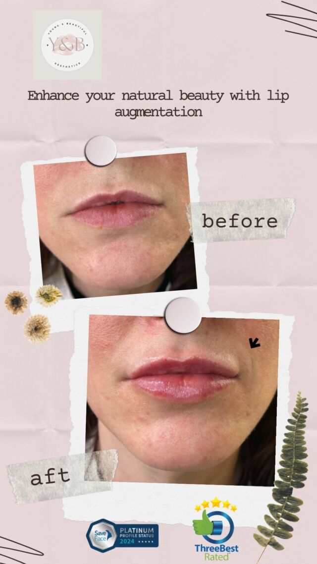 👄Enhancing natural beauty with 1ml of Juvederm Volift. 👄Witness how this non-surgical treatment can beautifully enhance lip volume and definition, creating a natural and youthful appearance.  The results speak for themselves - a subtle yet impactful transformation that boosts confidence and accentuates your features.Give this post a ❤️ let's elevate beauty, empower confidence, and celebrate the art of self-love! 👄✨#lipaugmentation #lipfillernorthampton #juvedermvolift #lipfillernorthamptonshire #aestheticsnorthamptonshire #aestheticsnorthampton #medicalaestheticsclinic #liptransformation #EmpowerBeauty
