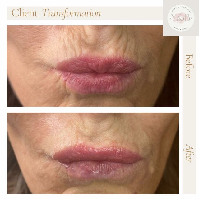 Before: Are pesky peri oral lines making you look older than you feel? We have the solution for you!After: Check out the amazing results of Juvederm Volift injected to peri oral lines! Say goodbye to wrinkles and hello to a more youthful appearance.Book your appointment today and get ready to love your new look! 💉✨#JuvedermVolift #PeriOralLines #TransformationTuesday